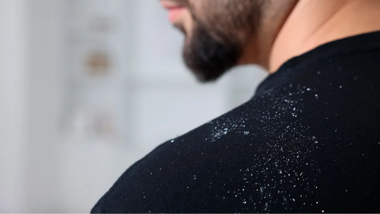 Entiende todo sobre la caspa y cómo evitarla